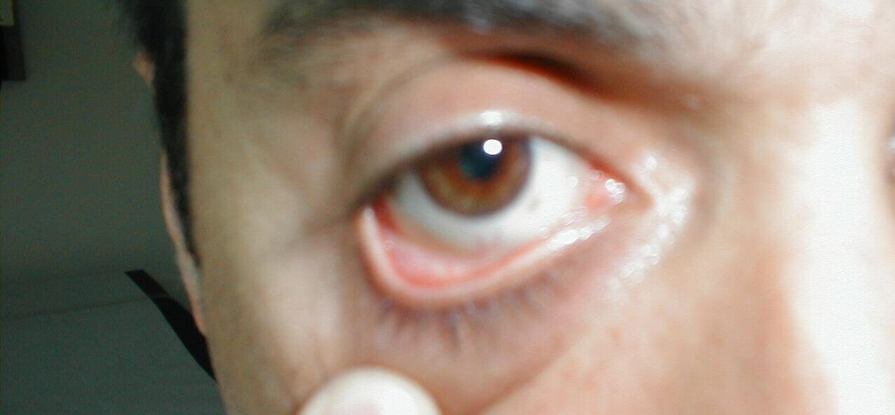 Normal conjunctival reflection