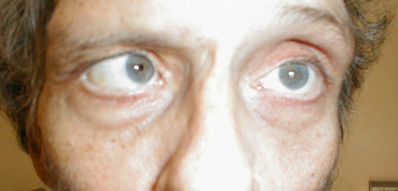 eyes-cn6-palsy