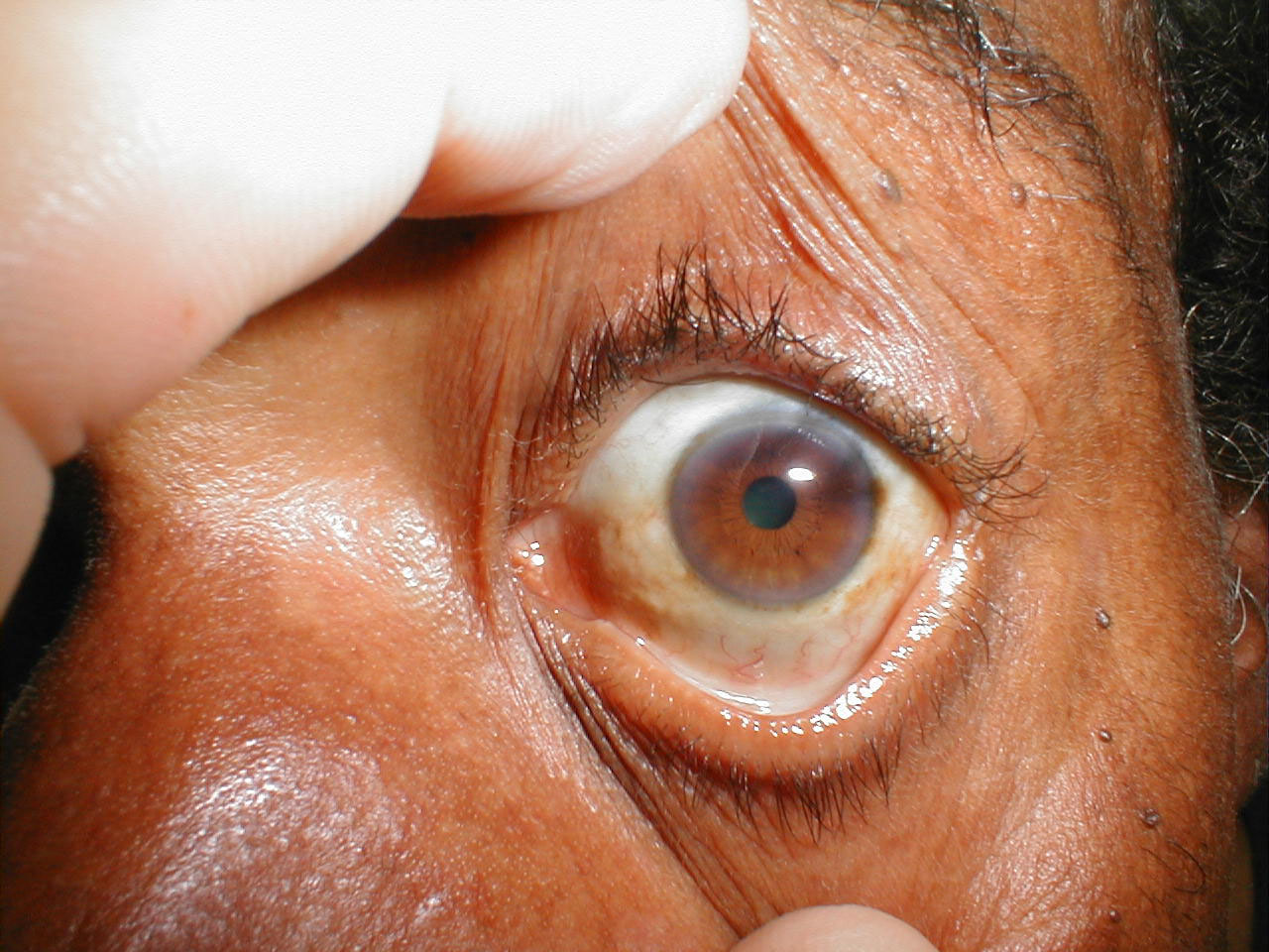 eyes-muddy brown sclera