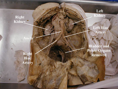 Gross Retroperitoneum Anatomy