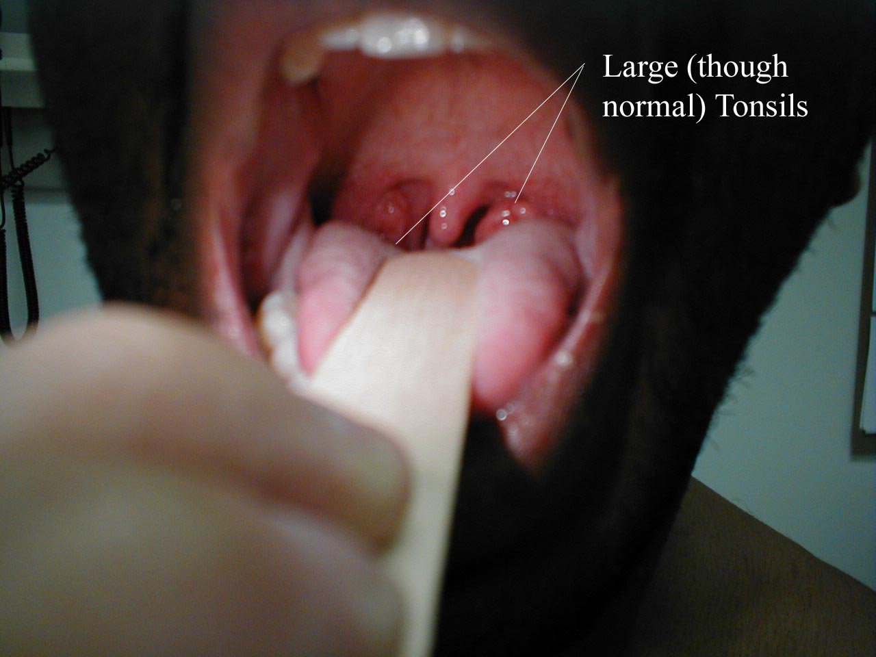 Oral Gonorrhea Symptoms Signs