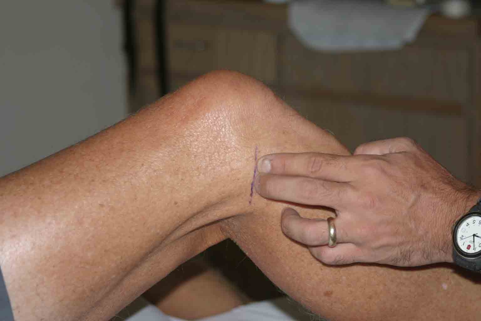 Palpation Along Lateral Joint Lines