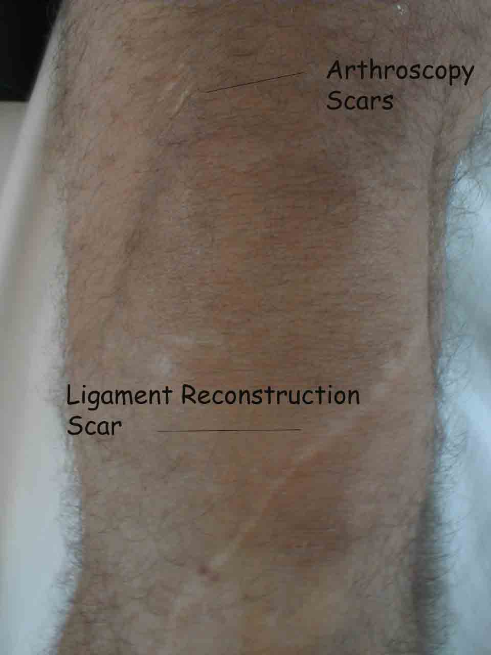 Ligament reconstruction scars