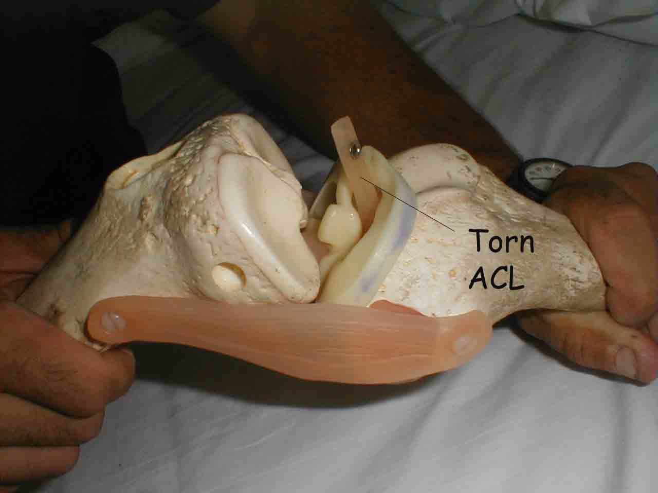 Simmulated Torn ACL