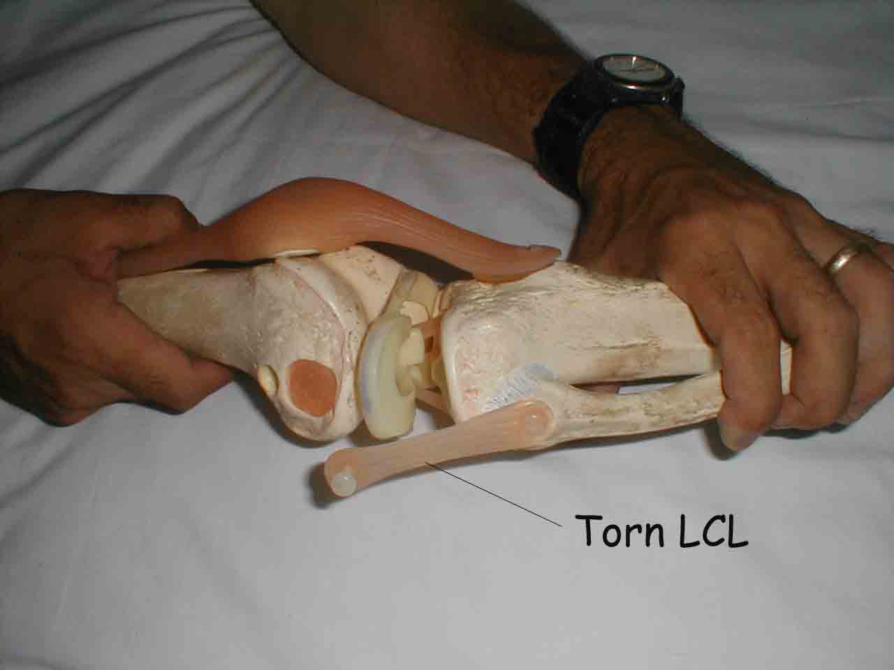 Torn LCL Model
