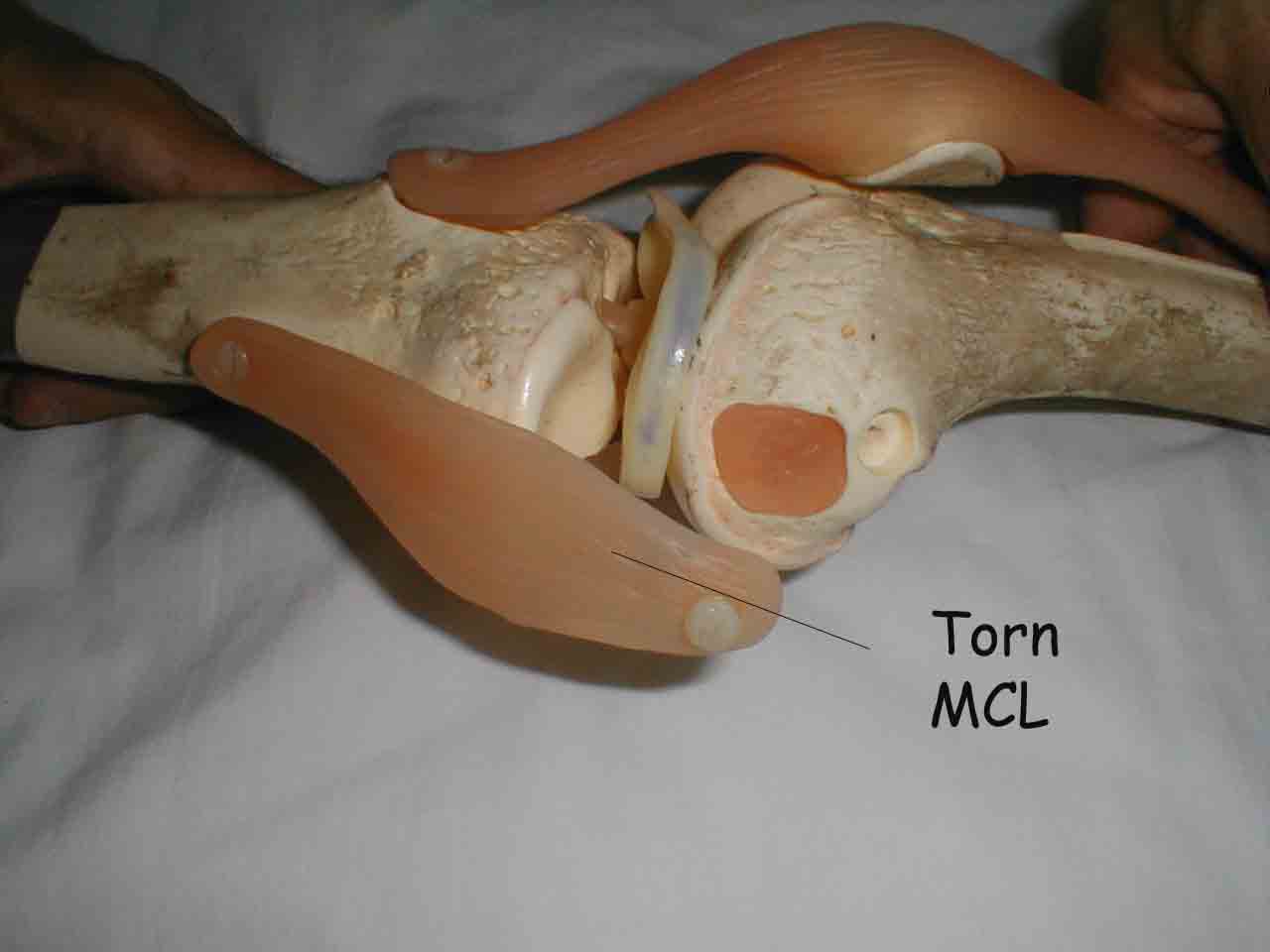Simmulated Torn MCL