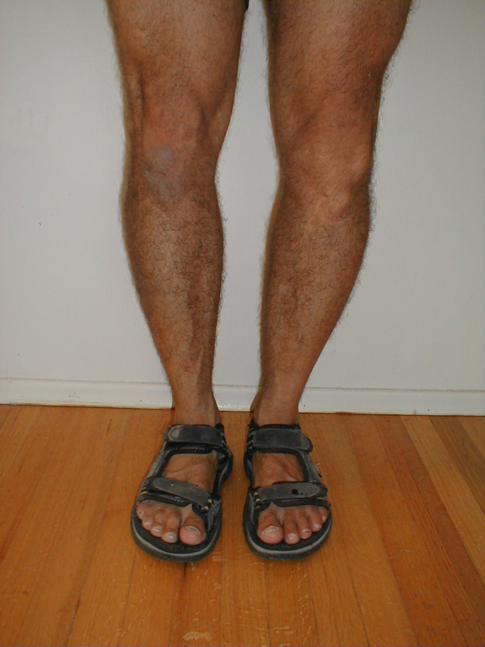 Varus Knee Deformity