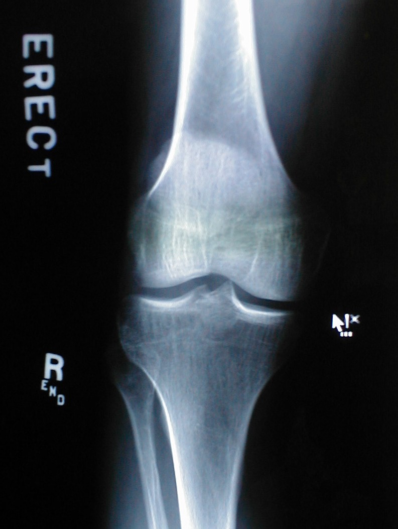 X-Ray of Normal Knee