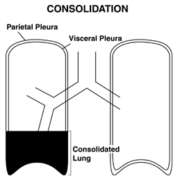 Lung consolidation