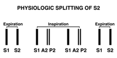 Physiologic splitting of S2
