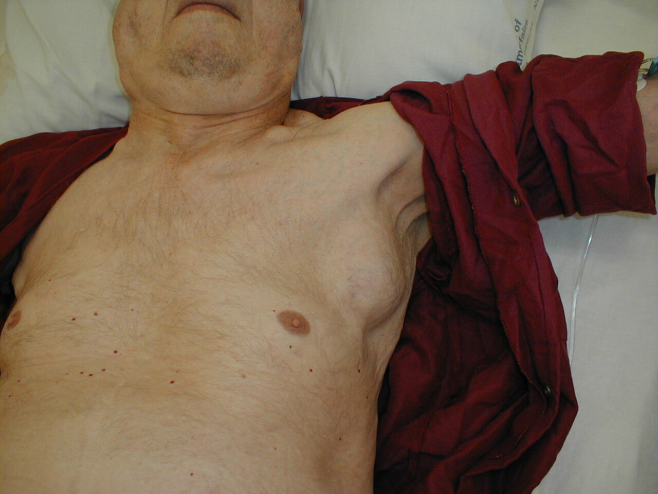 Left Axillary Adenopathy