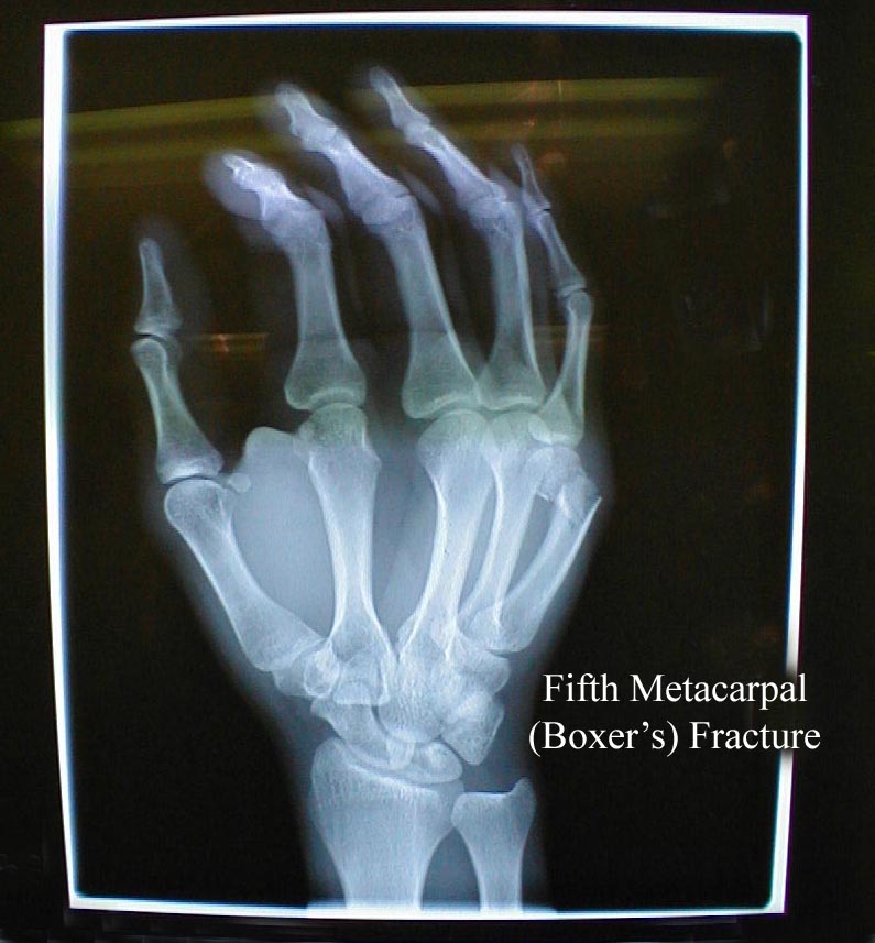 Boxer's Fracture x-ray