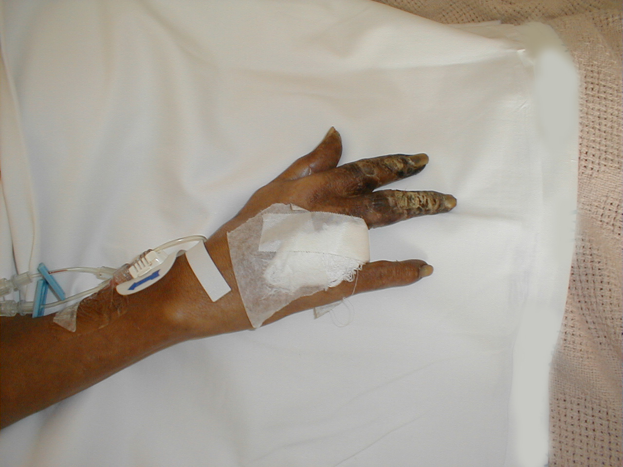 Peripheral Vascular Disease, Hand